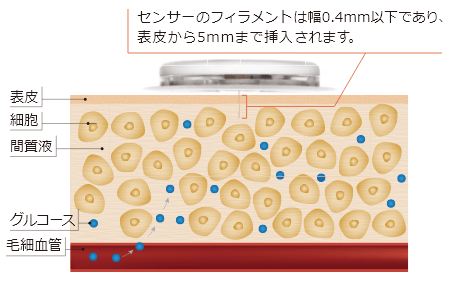 センサーのフィラメントは幅0.4mm以下であり、表皮から5mmまで挿入されます。